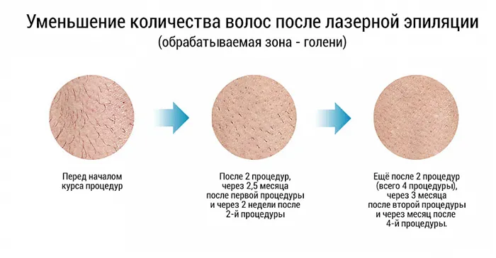 Почему выбирают лазерную эпиляцию