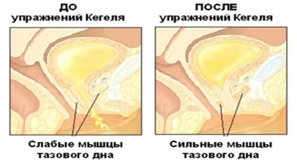 Упражнения Кегеля