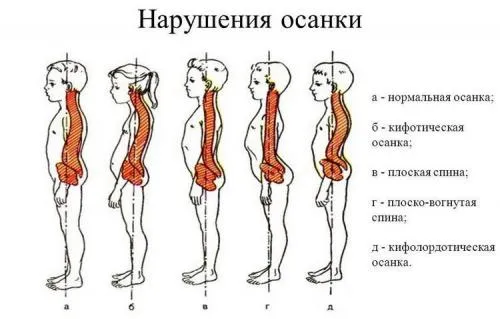 Можно ли спать в корсете для спины. Как правильно подобрать ортопедическое изделие