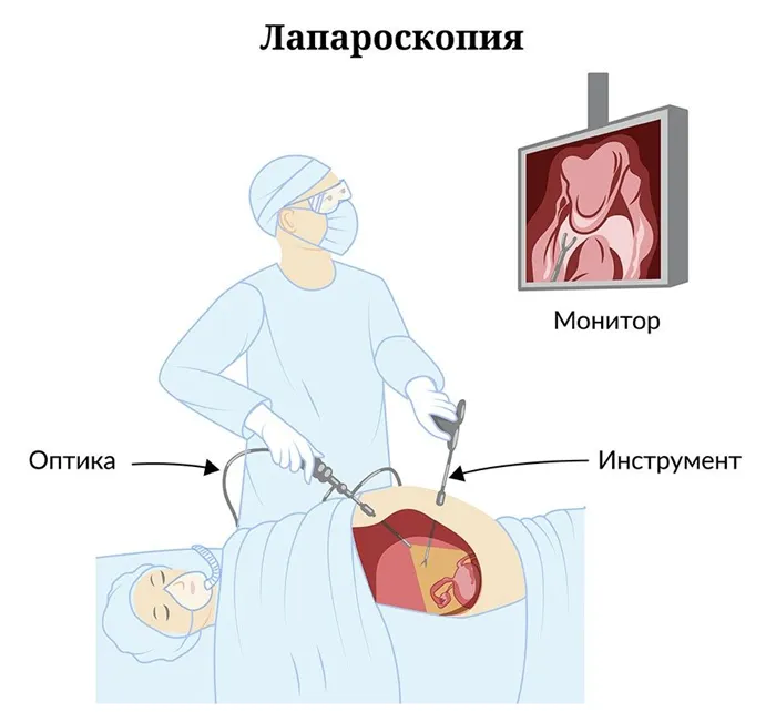 Лапароскопия