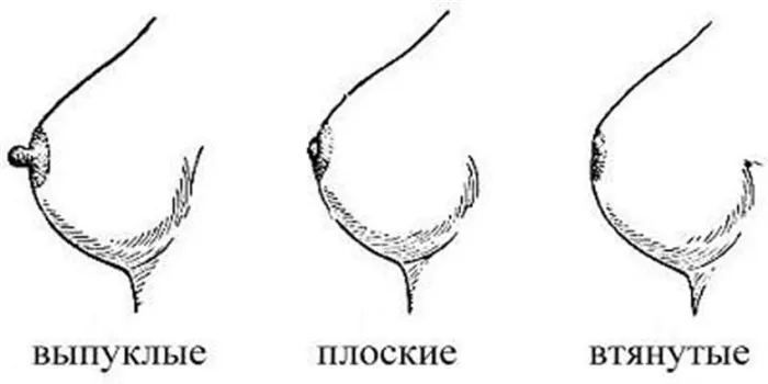 Молочные железы: аномалии