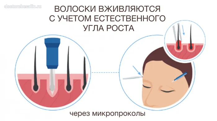 Пересадка волосков в зону бровей проводится через микропроколы в коже