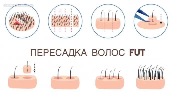 Пересадка волос FUТ – устаревшая лоскутная технология