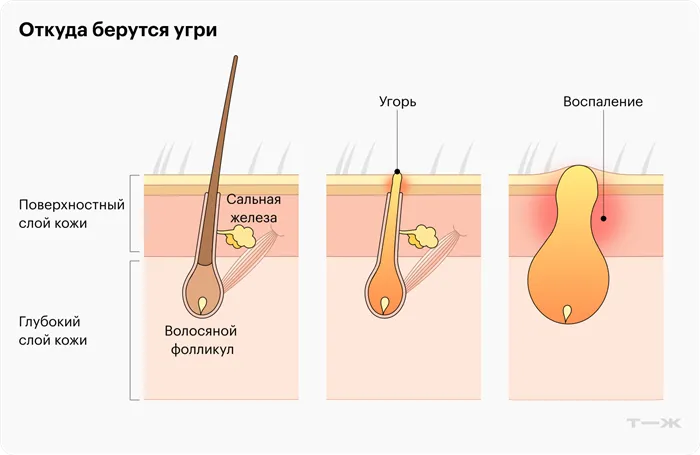 Когда пробка из кожного сала и омертвевших клеток закупоривает волосяной фолликул, замурованные внутри бактерии вызывают иммунный ответ и на коже появляется гнойник